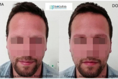 DERMOPIGMENTAZIONE SOPRACCIGLIA UOMO