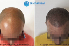 tricopigmentazione - effetto rasato
