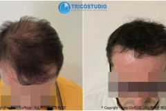 1_tricopgmentazione