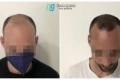 tricopigmentazione