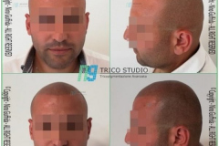tricopigmentazione