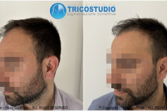 tricopigmentazione