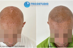 tricopigmentazione