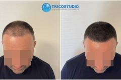 tricopigmentazione