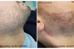 tricopigmentazione-barba