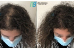 tricopigmentazione-donna