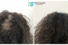 tricopigmentazione-donna