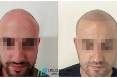 tricopigmentazione-effetto-rasato