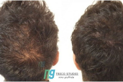 tricopigmentazione-vertex