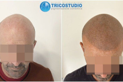tricopigmentazione