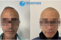 tricopigmentazione