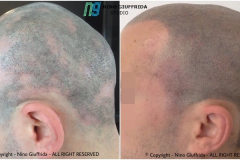 Alopecia