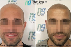 Tricopigmentazione