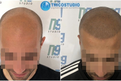 Tricopigmentazione-Effetto-rasato
