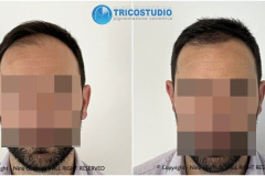 Tricopigmentazione-effetto-rinfoltimento