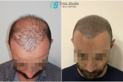 TRICOPIGMENTAZIONE