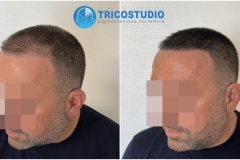 rinfoltimento-su-autotrapianto