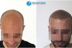 tricopigmentazione - effetto rasato