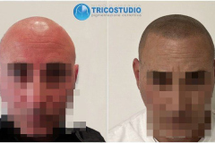 tricopigmentazione