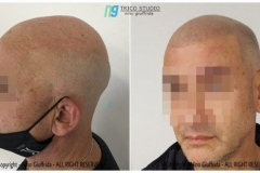 Tricopigmentazione