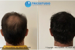 tricopgmentazione-1