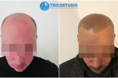 tricopgmentazione