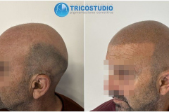 tricopigmentazione