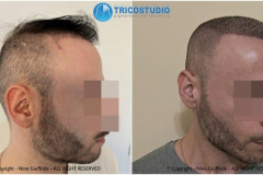 tricopigmentazione