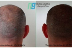 tricopigmentazione