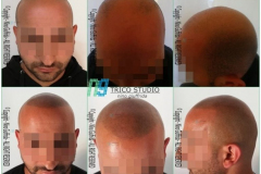 tricopigmentazione