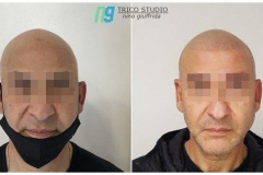 tricopigmentazione
