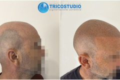 tricopigmentazione