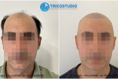 tricopigmentazione