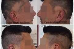 tricopigmentazione