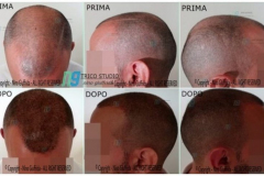 tricopigmentazione