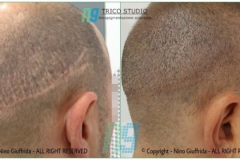 tricopigmentazione