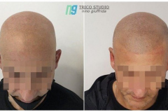 tricopigmentazione