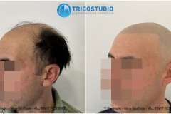 tricopigmentazione