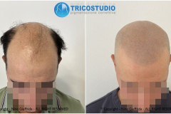tricopigmentazione