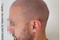 tricopigmentazione