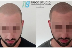 Tricopigmentazione