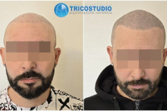 tricopigmentazione