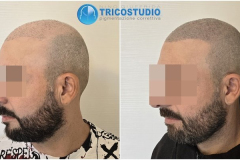 tricopigmetazione